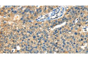 Immunohistochemistry of paraffin-embedded Human breast cancer tissue using DHCR24 Polyclonal Antibody at dilution 1:40 (Seladin 1 antibody)