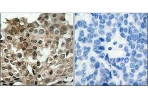 Immunohistochemistry analysis of paraffin-embedded human breast carcinoma tissue, using FKHRL1 (Ab-253) Antibody. (FOXO3 antibody  (AA 220-269))