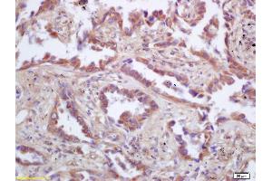Formalin-fixed and paraffin embedded human lung carcinoma labeled with Rabbit Anti p53AIP1 Polyclonal Antibody, Unconjugated (ABIN872405) at 1:200 followed by conjugation to the secondary antibody and DAB staining (TP53AIP1 antibody  (AA 65-124))