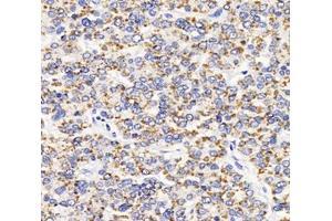 Immunohistochemistry analysis of paraffin-embedded human liver cancer using AGXT (ABIN7072987) at dilution of 1: 2000 (AGXT antibody)