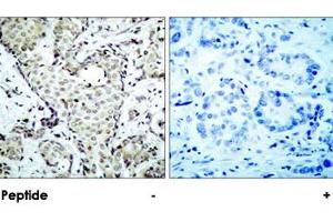 Immunohistochemical analysis of paraffin-embedded human breast carcinoma tissue using MAP2K6 polyclonal antibody . (MAP2K6 antibody  (Ser207))