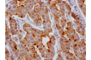 IHC image of ABIN7127563 diluted at 1:100 and staining in paraffin-embedded human breast cancer performed on a Leica BondTM system. (Recombinant IGFBP2 antibody)