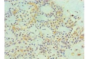 Immunohistochemistry of paraffin-embedded human breast cancer using ABIN7159251 at dilution of 1:100 (MAGEA1 antibody  (AA 1-309))