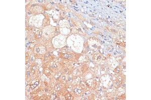 Immunohistochemistry of paraffin-embedded human liver cancer using RIPK3 antibody (ABIN6132598, ABIN6146964, ABIN6146967 and ABIN6221084) at dilution of 1:100 (40x lens). (RIPK3 antibody  (AA 1-120))