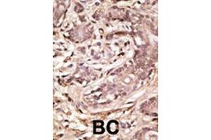 Formalin-fixed and paraffin-embedded human cancer tissue reacted with the primary antibody, which was peroxidase-conjugated to the secondary antibody, followed by AEC staining. (SUMO4 antibody  (AA 34-63))