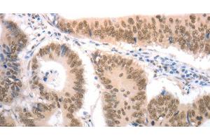Immunohistochemistry of paraffin-embedded Human colon cancer tissue using RAD52 Polyclonal Antibody at dilution 1:50 (RAD52 antibody)