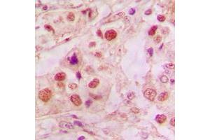 Immunohistochemical analysis of p53 staining in human lung cancer formalin fixed paraffin embedded tissue section.