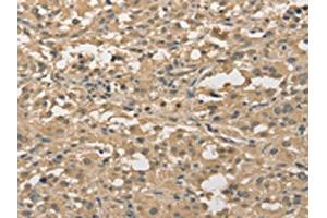 The image on the left is immunohistochemistry of paraffin-embedded Human thyroid cancer tissue using ABIN7128351(ALDH8A1 Antibody) at dilution 1/30, on the right is treated with fusion protein. (ALDH8A1 antibody)