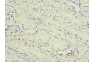 Immunohistochemistry of paraffin-embedded human gastric cancer using ABIN7151252 at dilution of 1:100 (TRIM23 antibody  (AA 1-280))