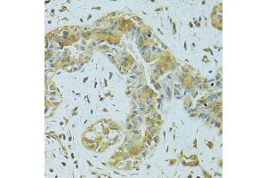 Immunohistochemistry of paraffin-embedded human breast cancer using MTCH1 antibody (ABIN5975695) at dilution of 1/100 (40x lens). (MTCH1 antibody)