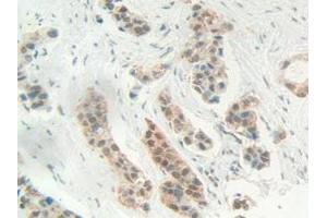IHC-P analysis of Human Breast cancer Tissue, with DAB staining. (HMGB1 antibody  (AA 1-215))