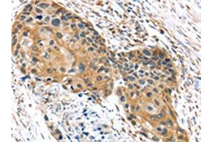 The image on the left is immunohistochemistry of paraffin-embedded Human esophagus cancer tissue using ABIN7192977(UBTD1 Antibody) at dilution 1/30, on the right is treated with synthetic peptide. (UBTD1 antibody)