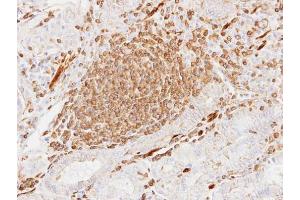 IHC-P Image Immunohistochemical analysis of paraffin-embedded human gastric cancer, using alpha Actin (cardiac muscle), antibody at 1:100 dilution.