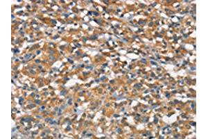 The image on the left is immunohistochemistry of paraffin-embedded Human thyroid cancer tissue using ABIN7189845(APOA1BP Antibody) at dilution 1/15, on the right is treated with synthetic peptide. (APOA1BP antibody)