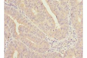 Immunohistochemistry of paraffin-embedded human endometrial cancer using ABIN7161139 at dilution of 1:100 (COBRA1 antibody  (AA 8-199))