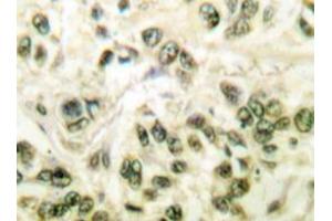 Immunohistochemistry analyzes of SMAP45 antibody in paraffin-embedded human breast carcinoma tissue. (HDAC3 antibody)