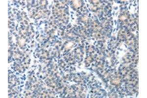 The image on the left is immunohistochemistry of paraffin-embedded Human thyroid cancer tissue using ABIN7128892(CEACAM1 Antibody) at dilution 1/25, on the right is treated with fusion protein. (CEACAM1 antibody)