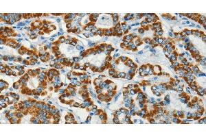 Immunohistochemistry of paraffin-embedded Human thyroid cancer using BCAT2 Polyclonal Antibody at dilution of 1:70 (BCAT2 antibody)