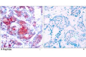 Immunohistochemical analysis of paraffin-embedded human breast carcinoma tissue using STAT4 (phospho Y693) polyclonal antibody. (STAT4 antibody  (pTyr693))