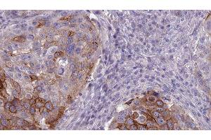 ABIN6275973 at 1/100 staining Human urothelial cancer tissue by IHC-P. (BAI1 antibody  (Internal Region))