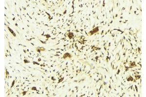 ABIN6269246 at 1/100 staining Human breast cancer tissue by IHC-P.