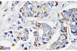 Immunohistochemistry of paraffin-embedded Human breast cancer using KMT2E Polyclonal Antibody at dilution of 1:200 (40x lens).