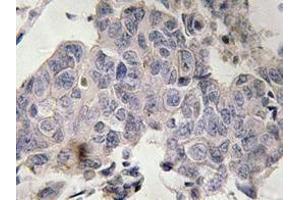 Immunohistochemistry analyzes of STAM2 antibody in paraffin-embedded human lung carcinoma tissue. (STAM2 antibody)