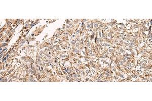 Immunohistochemistry of paraffin-embedded Human lung cancer tissue using NDUFB11 Polyclonal Antibody at dilution of 1:95(x200) (NDUFB11 antibody)