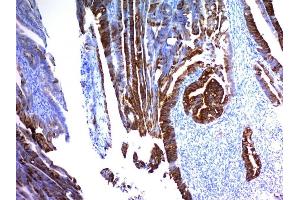 Formalin-fixed, paraffin-embedded human Colon Carcinoma stained with MUC2 Mouse Monoclonal Antibody (MLP/842). (MUC2 antibody)