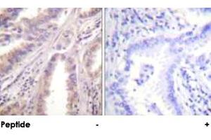 Immunohistochemical analysis of paraffin-embedded human lung carcinoma tissue using KIF11 polyclonal antibody . (KIF11 antibody)