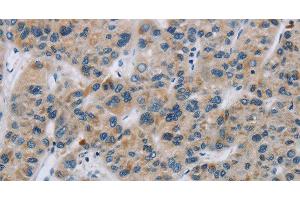 Immunohistochemistry of paraffin-embedded Human liver cancer using SYN2 Polyclonal Antibody at dilution of 1:40