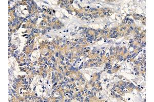 ABIN6261841 and ABIN6278571 at 1/100 staining human colorectal cancer by IHC-P. (FZD7 antibody  (C-Term))