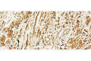 Immunohistochemistry of paraffin-embedded Human prost ate cancer tissue using TCF7 Polyclonal Antibody at dilution of 1:30(x200)