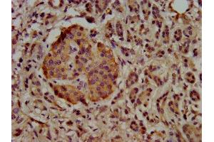 IHC image of ABIN7174451 diluted at 1:500 and staining in paraffin-embedded human pancreatic cancer performed on a Leica BondTM system. (UBE2G1 antibody  (AA 2-170))