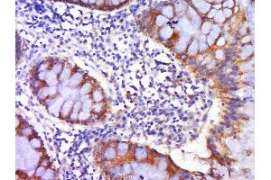 Paraformaldehyde-fixed, paraffin embedded human colon carcinoma tissue, Antigen retrieval by boiling in sodium citrate buffer(pH6) for 15min, Block endogenous peroxidase by 3% hydrogen peroxide for 30 minutes, Blocking buffer (normal goat serum) at 37°C for 20min, Antibody incubation with Rabbit Anti-DR4 Polyclonal Antibody, Unconjugated  at 1:500 overnight at 4°C, followed by a conjugated secondary and DAB staining (DR4 antibody  (AA 401-468))