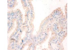 Immunohistochemistry of paraffin-embedded human bladder cancer using ABIN7162048 at dilution of 1:50 (NME1 antibody  (AA 2-152))