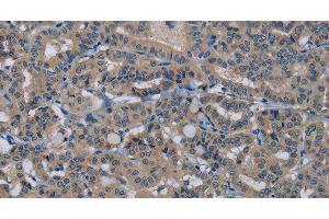 Immunohistochemistry of paraffin-embedded Human thyroid cancer tissue using HSPG2 Polyclonal Antibody at dilution 1:50 (HSPG2 antibody)