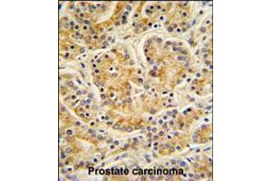 MOBKL1B Antibody IHC analysis in formalin fixed and paraffin embedded human Prostate carcinoma followed by peroxidase conjugation of the secondary antibody and DAB staining. (MOB1A antibody  (C-Term))