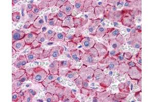 Immunohistochemistry (IHC) image for anti-Cadherin 1, Type 1, E-Cadherin (Epithelial) (CDH1) (Middle Region) antibody (ABIN2784498) (E-cadherin antibody  (Middle Region))