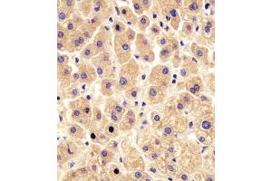 (ABIN6243863 and ABIN6578454) staining PYGL in human liver tissue sections by Immunohistochemistry (IHC-P - paraformaldehyde-fixed, paraffin-embedded sections). (PYGL antibody  (AA 809-843))
