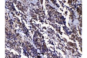 IHC testing of FFPE human lung cancer tissue with RAN antibody at 1ug/ml.