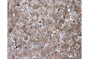 Immunohistochemical staining of paraffin-embedded Carcinoma of liver tissue using anti-TPMT mouse monoclonal antibody. (TPMT antibody)