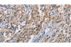 Immunohistochemistry of paraffin-embedded Human esophagus cancer using CBR1 Polyclonal Antibody at dilution of 1:40 (CBR1 antibody)