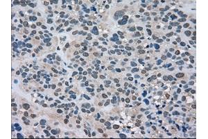 Immunohistochemical staining of paraffin-embedded Carcinoma of kidney tissue using anti-LDHAmouse monoclonal antibody. (Lactate Dehydrogenase A antibody)