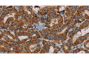 Immunohistochemistry of paraffin-embedded Human thyroid cancer using MRPL28 Polyclonal Antibody at dilution of 1:45 (MRPL28 antibody)