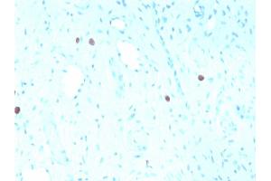 Formalin-fixed, paraffin-embedded human Cervix stained with HPV-16 Mouse Recombinant Monoclonal Antibody (rHPV16L1/1058).