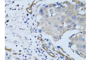 Immunohistochemistry of paraffin-embedded human breast cancer using MCAM antibody.