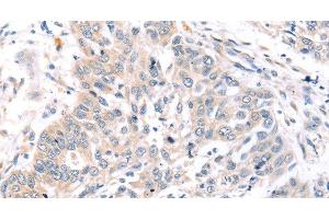 Immunohistochemistry of paraffin-embedded Human lung cancer tissue using ROR1 Polyclonal Antibody at dilution 1:45 (ROR1 antibody)