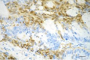 Immunohistochemistry was performed on paraffin-embedded human sigmoid colon carcinoma using creatine kinase B antibody (ABIN7798162), 1:200).
