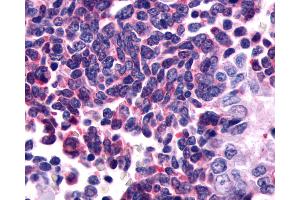 Anti-GPR162 antibody IHC of human Lung, Small Cell Carcinoma.